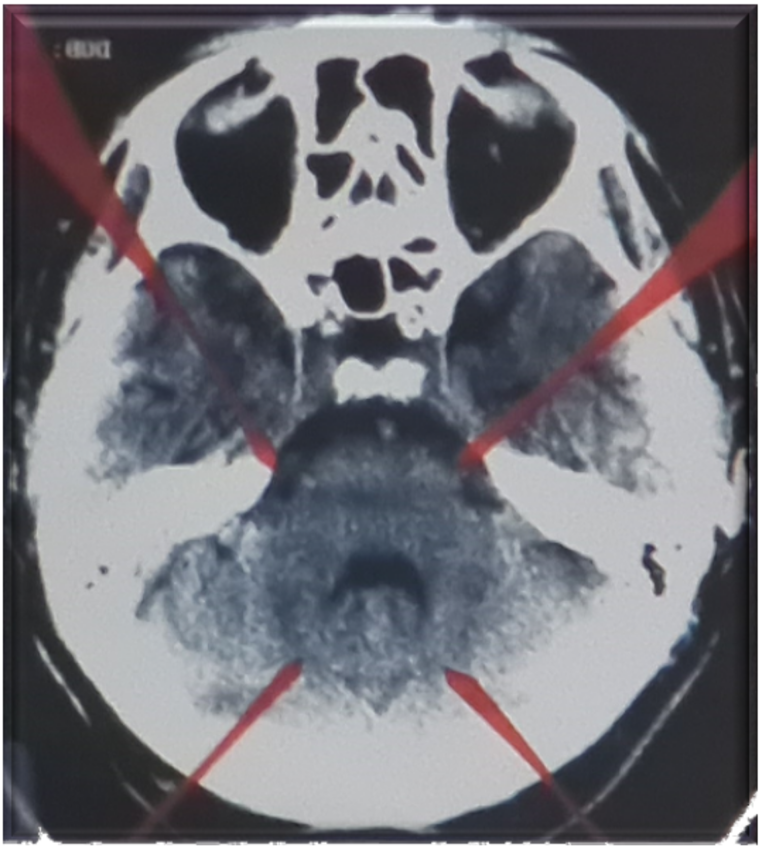 Hamer Focus in the brain