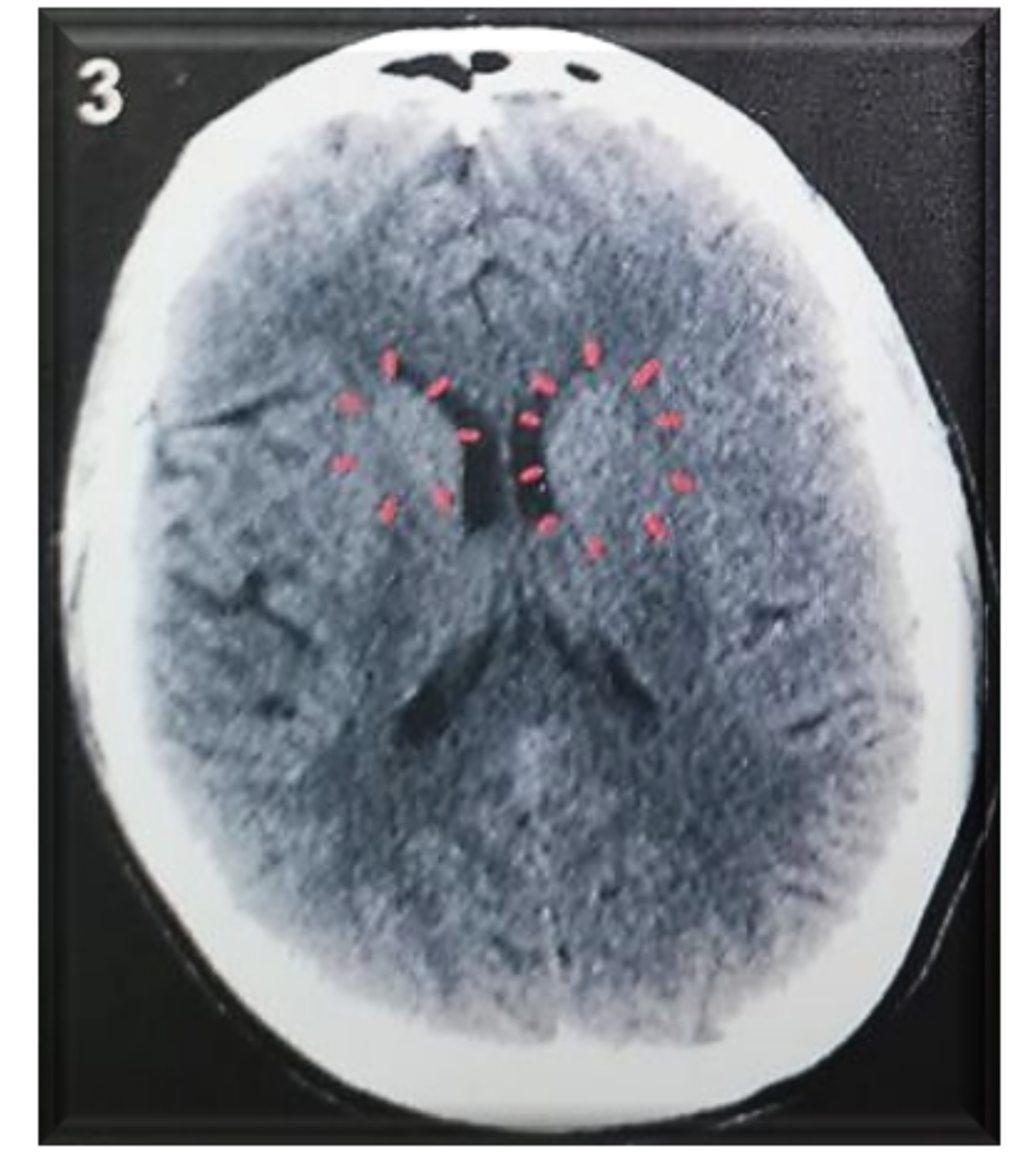 Brain CT showing Hamer Foci on the right and left myocardium
