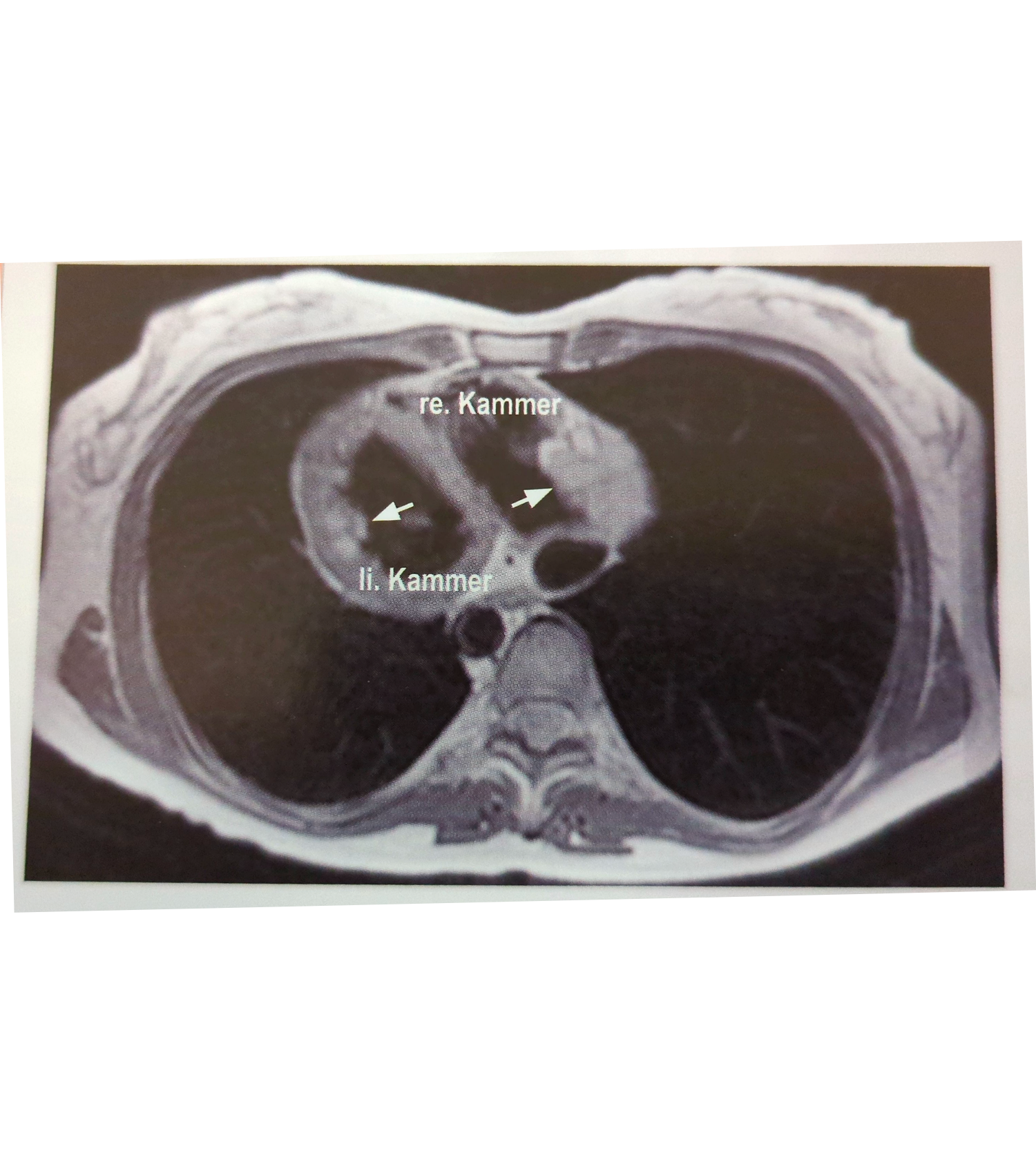 Organ CT showing the right and left myocardium